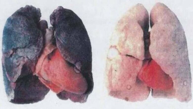 Many chronic alcoholics die from lung damage (left)
