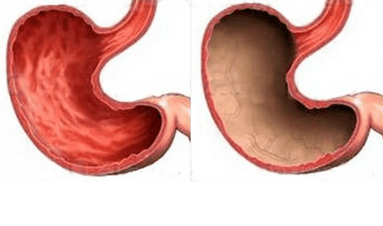 Ulcers, gastritis, cancer, and other stomach pathologies (on the right), which are apparently caused by alcohol